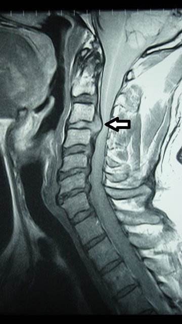 MRI-felvétel: nyakcsigolyák
