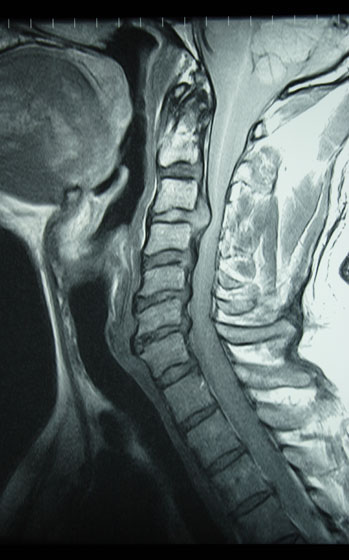 Mikor van szükség a nyakcsigolyák MRI felvételére? Nyakcsigolyák MRI