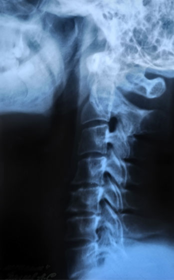 Röntgen: nyakcsigolyák