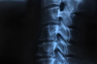 Nyakcsigolyák röntgenfelvétele