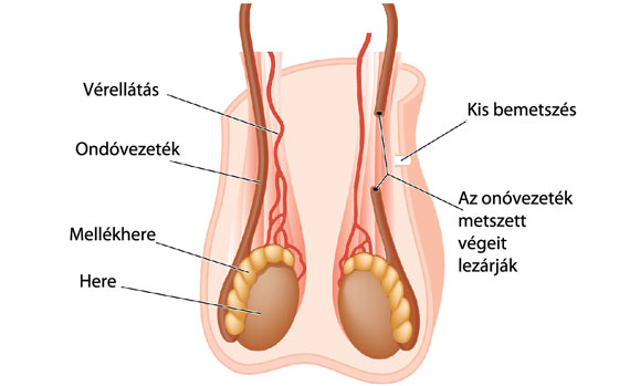 Ondóvezeték műtét