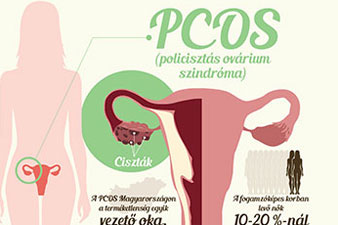 Milyen tünetek jelentkezhetnek a PCOS során?
