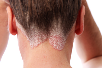 Pikkelysömör (pszoriázis, psoriasis) tünetei és kezelése