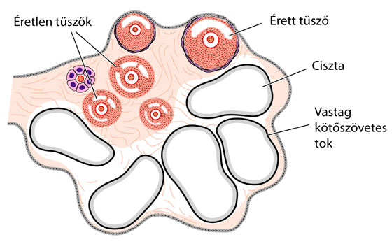 Cisztás petefészek ábra