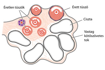 hólyaghurut petefészek gyulladás)