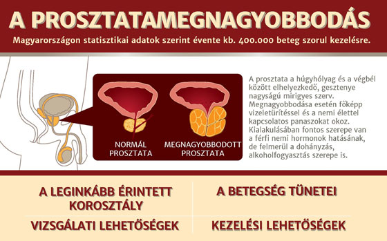 prosztata megbetegedés tünetei)