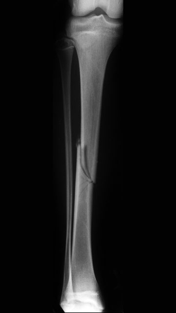 Röntgenfelvétel: sípcsonttörés