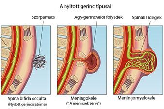 A nyitott gerinc típusai