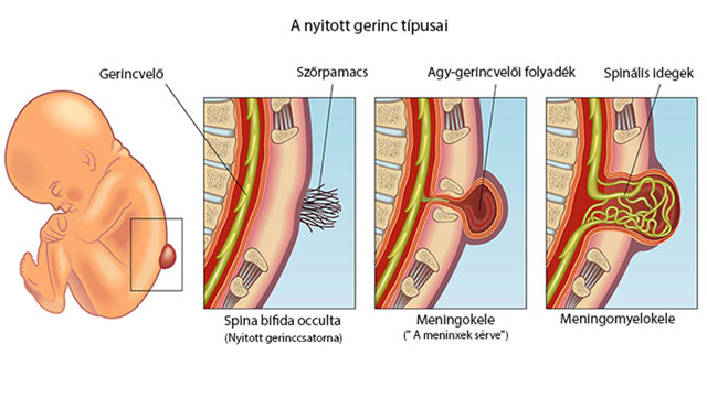 A nyitott gerinc típusai