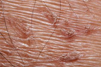 Mi okozhatja a száraz bőrt?
