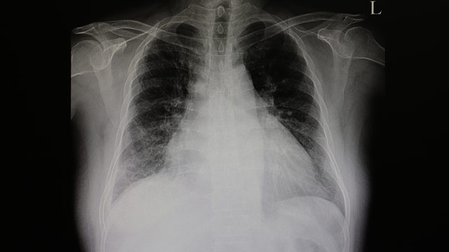 Szívmegnagyobbodás röntgenfelvétel