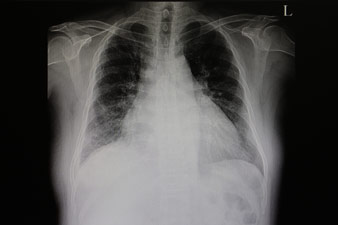 A szívmegnagyobbodás röntgenvizsgálata