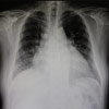 A szívmegnagyobbodás röntgenvizsgálata