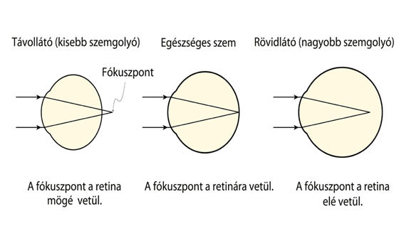 Rövidlátás, távollátás tünetei és kezelése