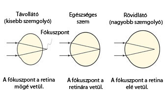 rövidlátás távolsága