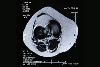 MRI kis medence prosztatitissel Prednizolon a prosztatitis