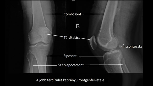 a térd ízületi röntgenfelvétele