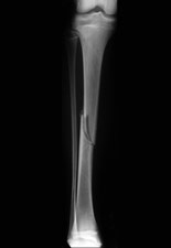 Röntgenfelvétel és sípcsonttörés