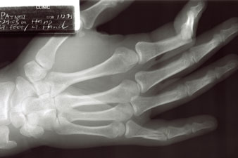 helminthiasis és ízületi fájdalmak a kéz arthrosisának kezelési módszerei