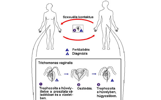 Trichomonas és a fertőzés módszerei)