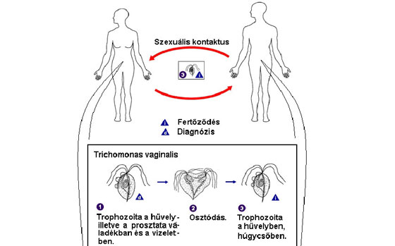 Trichomoniasis ábra