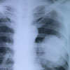 Tüdőrák röntgenfelvételen