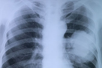 Röntgennel kimutatható a tüdőrák?