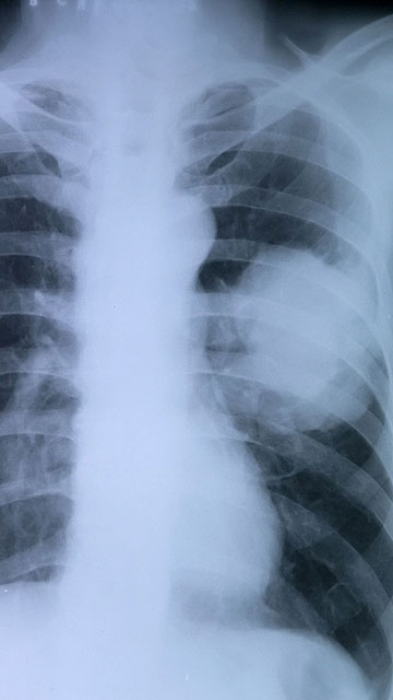 Tüdőrák röntgenfelvételen - Fotó: Dreamstime