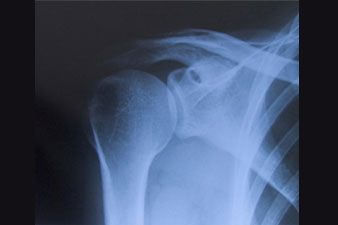Mikor van szükség a váll röntgenfelvételére?