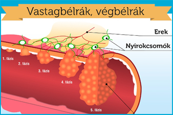 Szűréssel megelőzhető béldaganatos betegségek