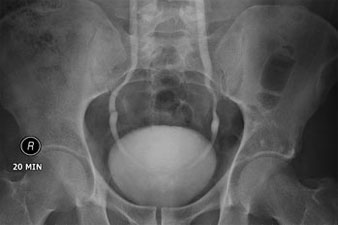 térdcsípő osteoarthritis kezelése a lábszövetek és ízületek kezelése