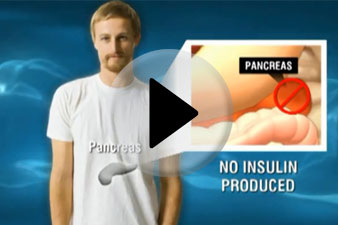 Pancreaselégtelenség cukorbetegekben – cukorbetegség pancreasbetegekben