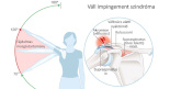 Impingement szindróma