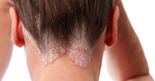 Psoriasis