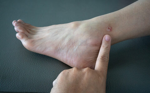 bőrbetegségek lábon