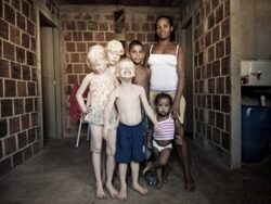 albínó gyermek
