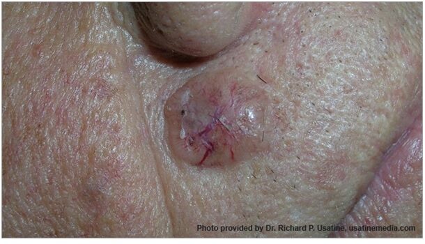 Seborrhoea, Seborrhoeas dermatitis - Bioderma webáruház