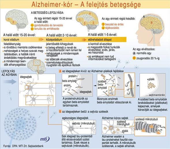 Alzheimer-kór - infografika, Forrás: MTI