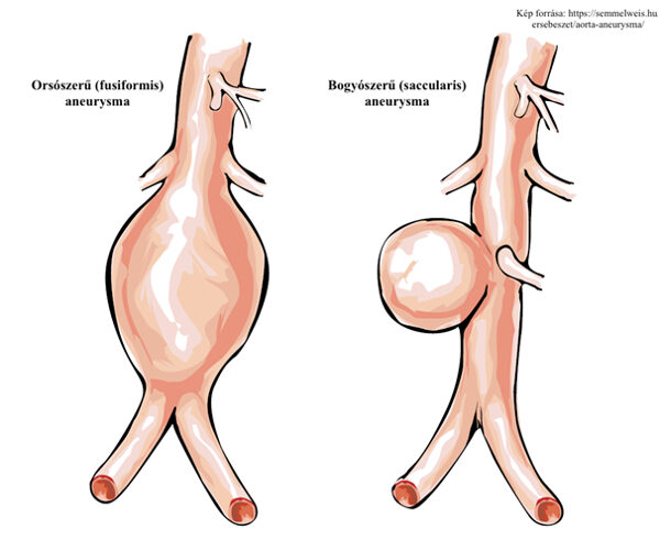 Aneurysma-típusok, Kép forrása: https://semmelweis.hu/ersebeszet/aorta-aneurysma