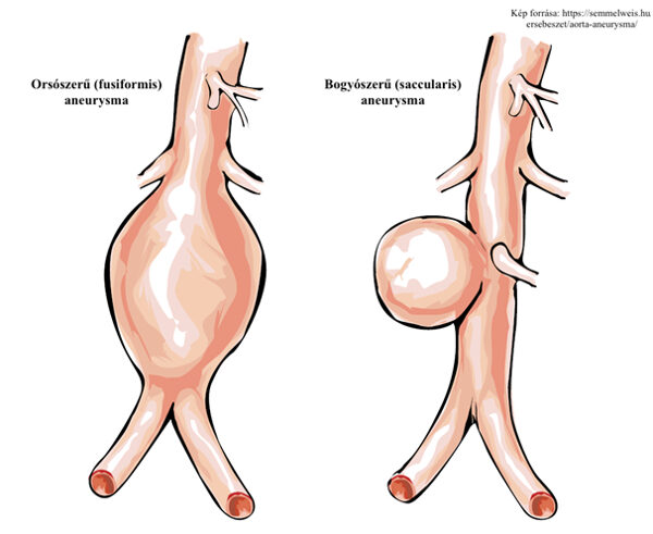 magas vérnyomás aneurysma
