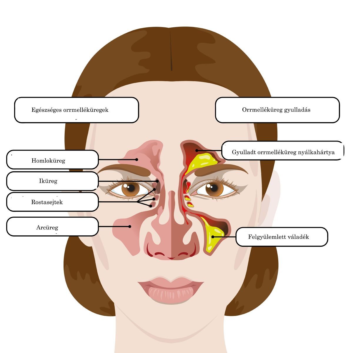 krónikus arcüreggyulladás szövődményei