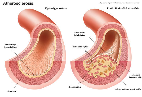 Atherosclerosis, Kép forrása: https://www.britannica.com/science/atherosclerosis