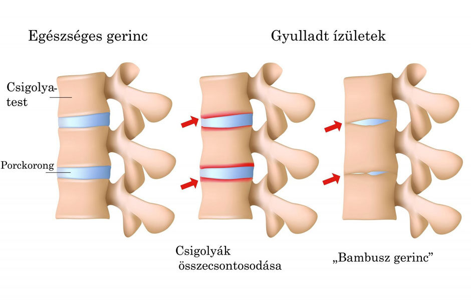 Bechterew-kór - Spondylitis ankylopoetica és látás