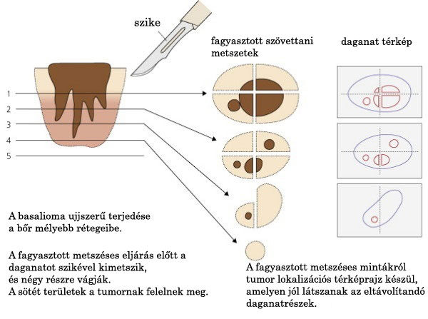 A fagyasztott metszéses eljárás előtt a daganatot szikével kimetszik