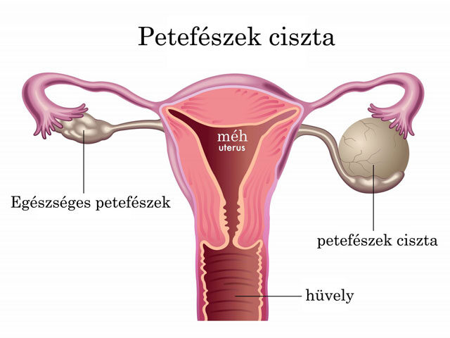 papilloma a nemi szervek területén