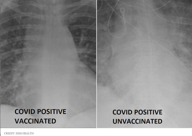 Covid és röntgenfelvételek