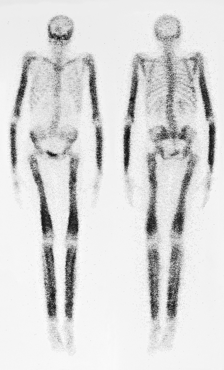 Csont-izotópvizsgálat felvétele
