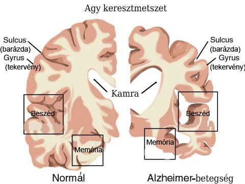 Egészséges személy és Alzheimer-kórban szenvedő beteg agyának összehasonlítása Egészséges személy és Alzheimer-kórban szenvedő beteg agyának összehasonlítása