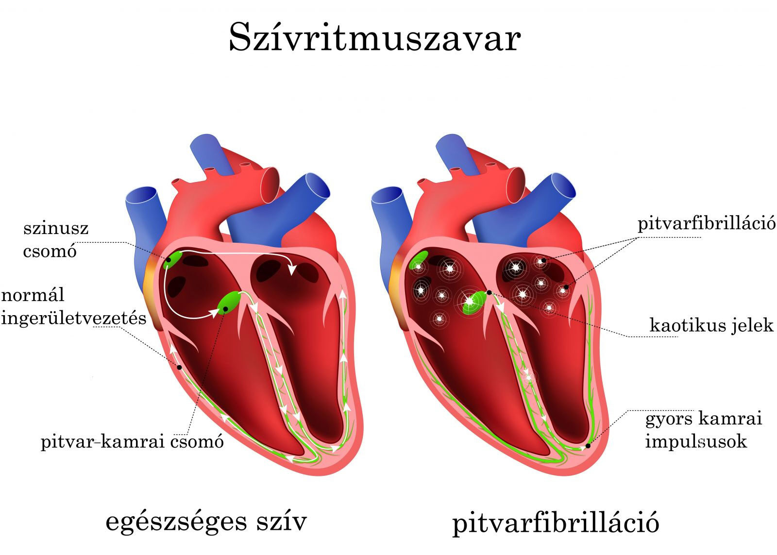 Egészséges szív/Pitvarfibrilláció
