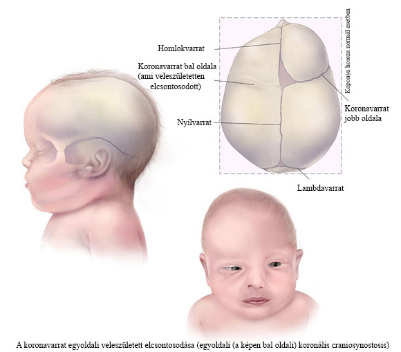 Egyoldali koronális craniosynostosis